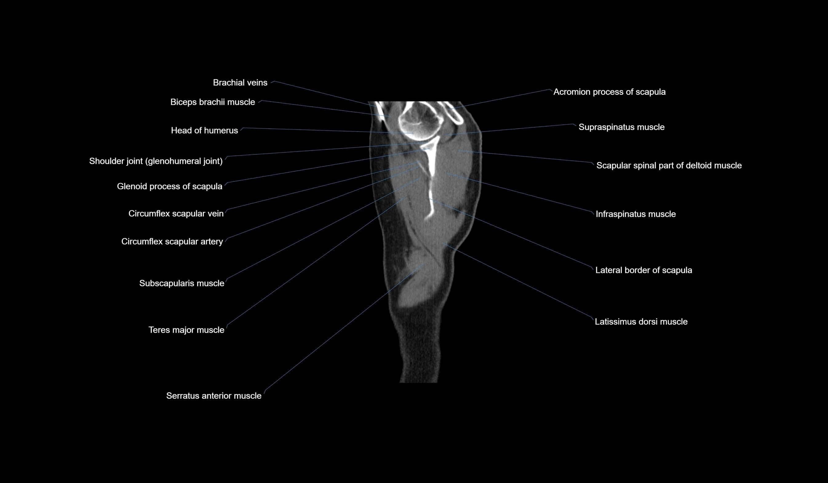 CT chest (thorax) soft tissue window labelled sagittal cross sectional anatomy radiology image-00007.webp